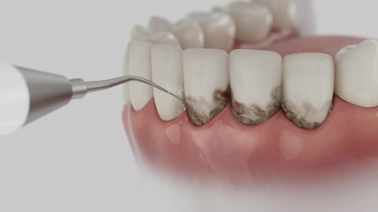 Reliable Dental Implants contractor in Highlands, CA by Smile Center Dentistry
